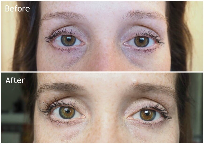 Rapidlash before and after